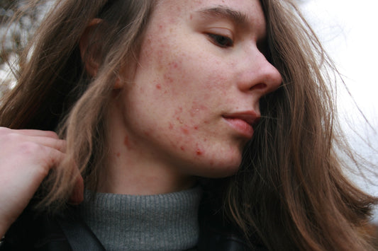 Clearing Up the Confusion: Tips for Managing Acne-Prone Skin